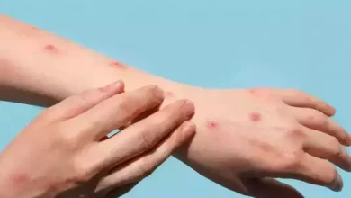 Photo of यूपी: कक्षा तीन के चार छात्रों में मिले मंकीपॉक्स के संदिग्ध लक्षण