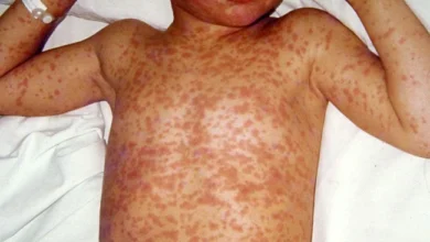 Photo of खसरे के ख़तरे में उत्तर प्रदेश के ये 41 जिले, विभाग ने जारी क्या अलर्ट…