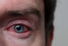 Photo of जिसे साधारण एलर्जी समझ रहे हैं, कहीं वो अर्बन आई सिंड्रोम तो नहीं?