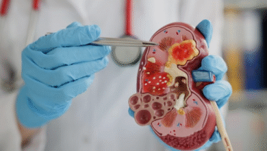 Photo of क्या आपको भी है किडनी स्टोन के दोबारा लौटने का डर?