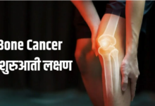 Photo of ये 5 लक्षण दिखें तो समझ जाएं हो गया है Bone Cancer, समय रहते नहीं दिया ध्यान तो पड़ जाएंगे लेने के देने