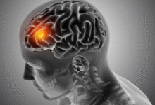 Photo of देश में तेजी से बढ़ रहीं न्यूरोलॉजिकल बीमारियां